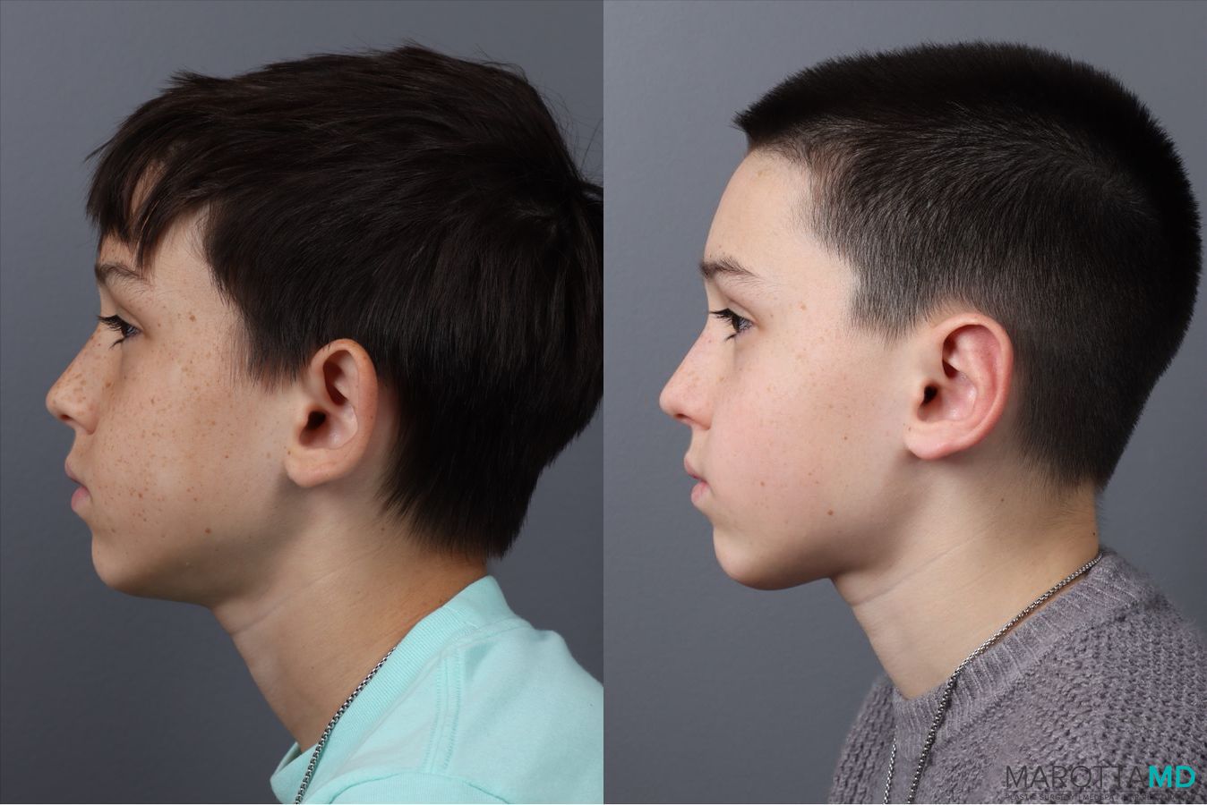 Before and after Otoplasty case 21380 - Angle 5