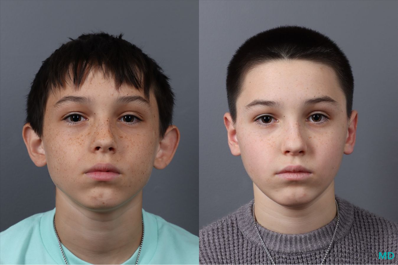 Before and after Otoplasty case 21380