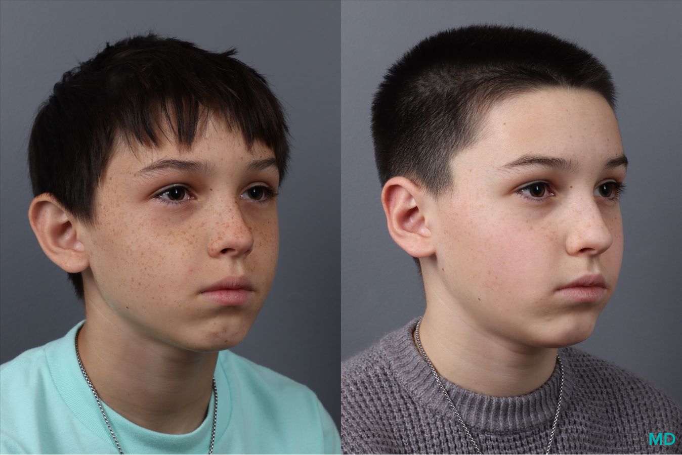 Before and after Otoplasty case 21380 - Angle 2