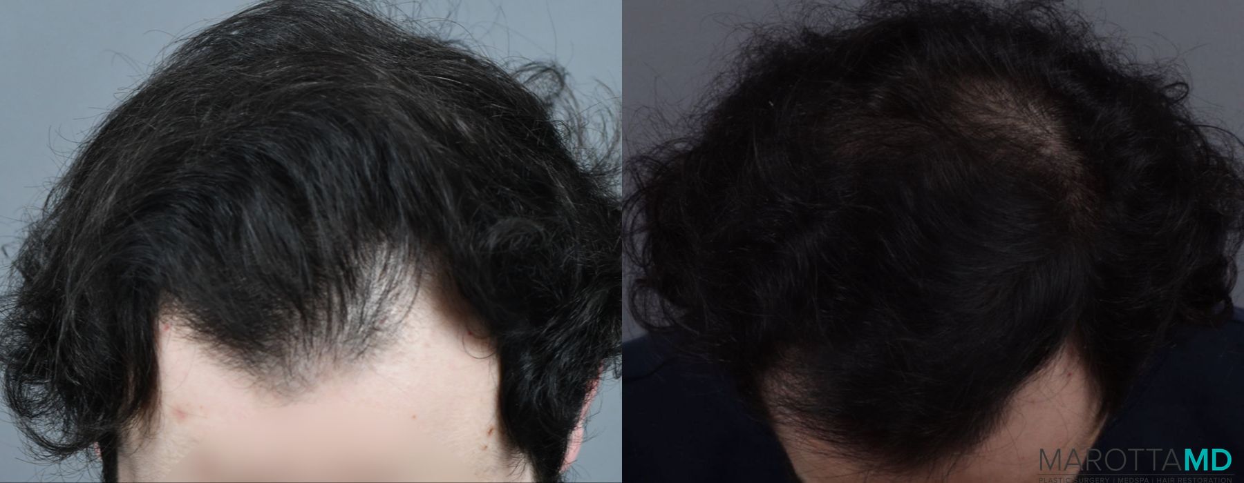 PRP Scalp Treatment - Case 288