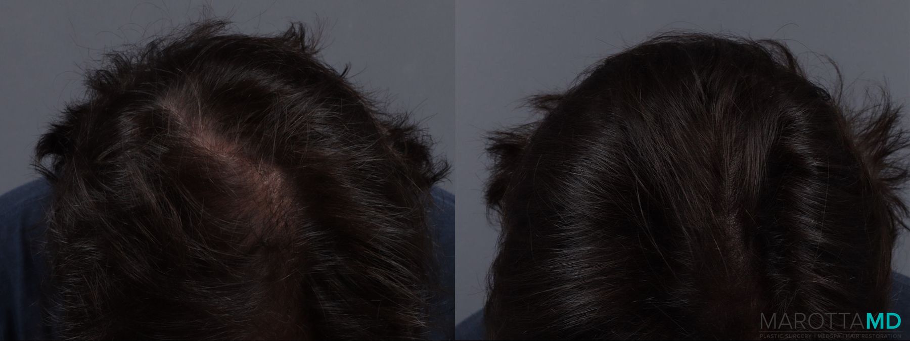 Before and after PRP Scalp Treatment case 13567 - Angle 3