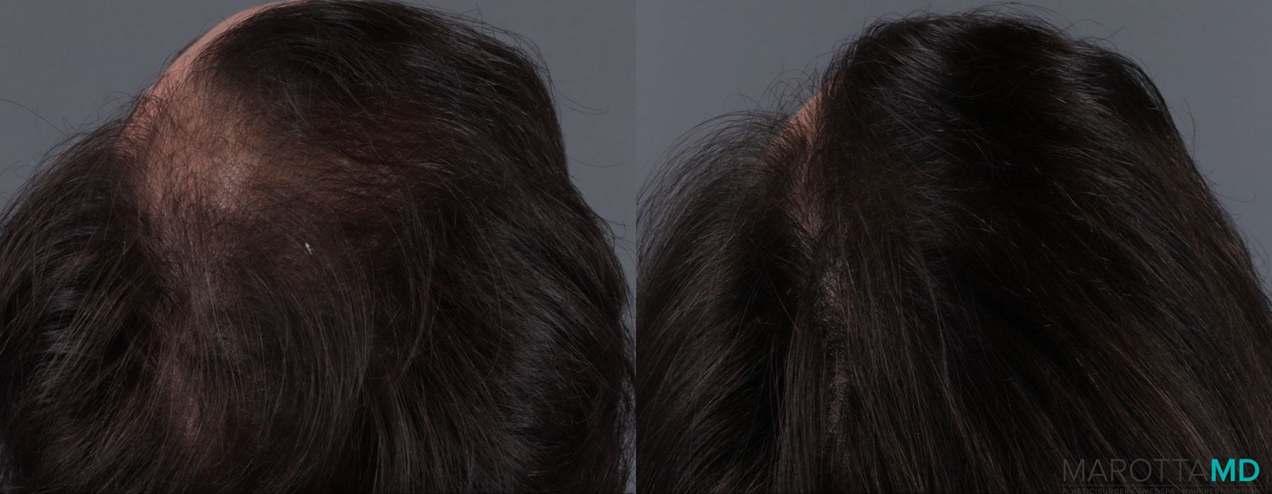 PRP Scalp Treatment - Thumbnail 4