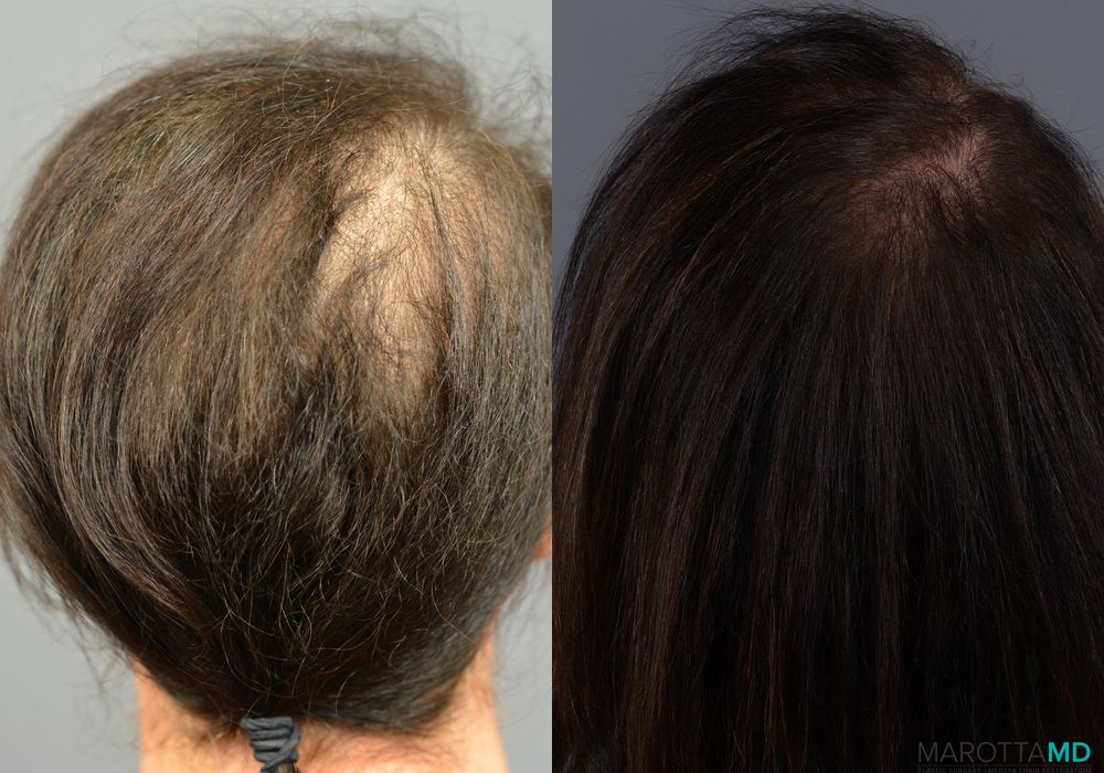 Before and after PRP Scalp Treatment case 7200 - Angle 4