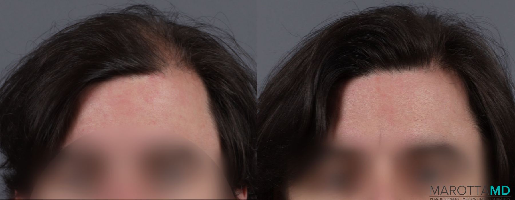 PRP Scalp Treatment - Case 657