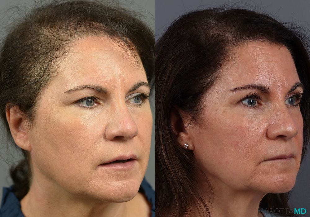 Before and after PRP Scalp Treatment case 7200 - Angle 3