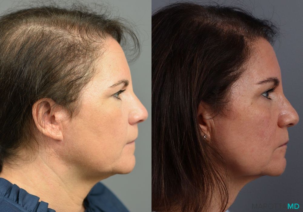Before and after PRP Scalp Treatment case 7200 - Angle 2