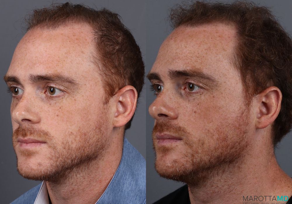 PRP Scalp Treatment - Case 285