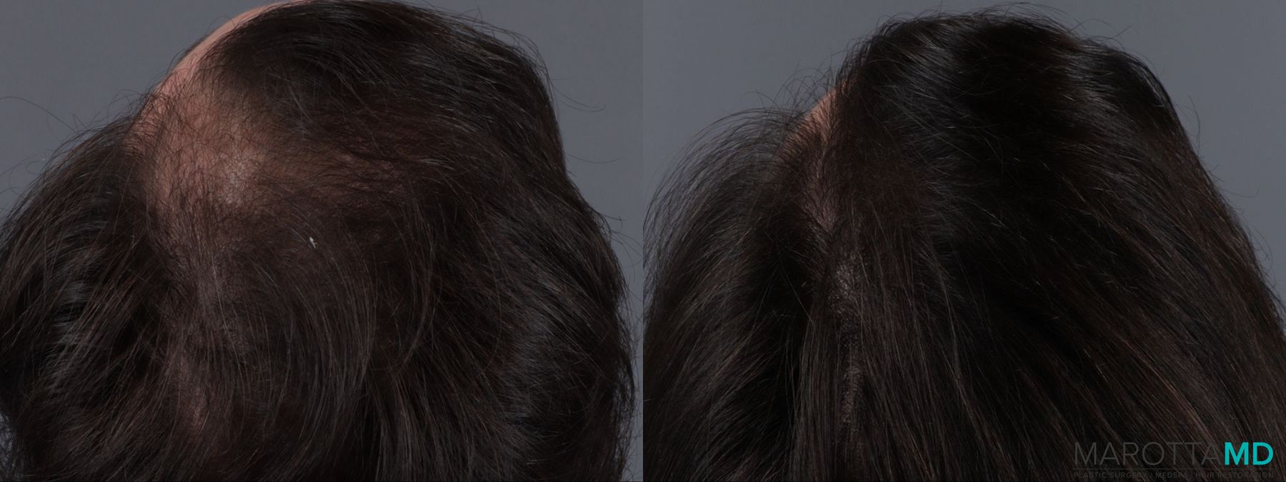 Before and after PRP Scalp Treatment case 13567 - Angle 4