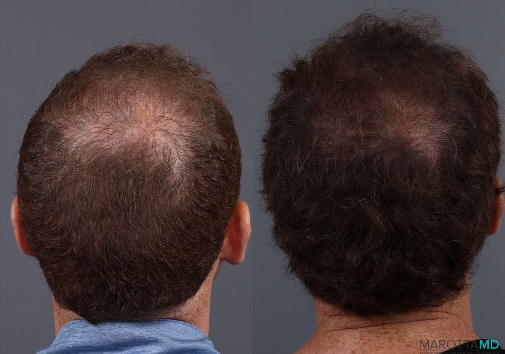 PRP Scalp Treatment - Thumbnail 4