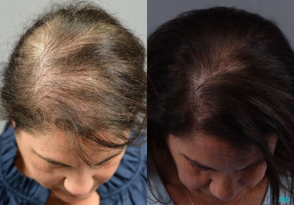 Before and after PRP Scalp Treatment case 7200