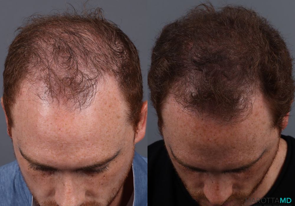 PRP Scalp Treatment - Thumbnail 3