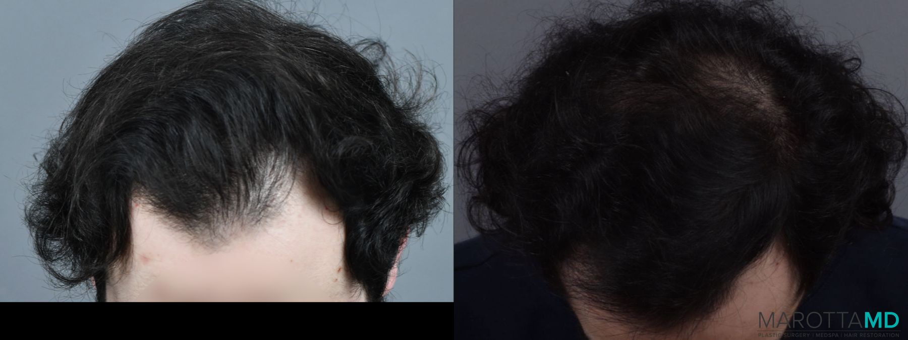 Before and after PRP Scalp Treatment case 13568