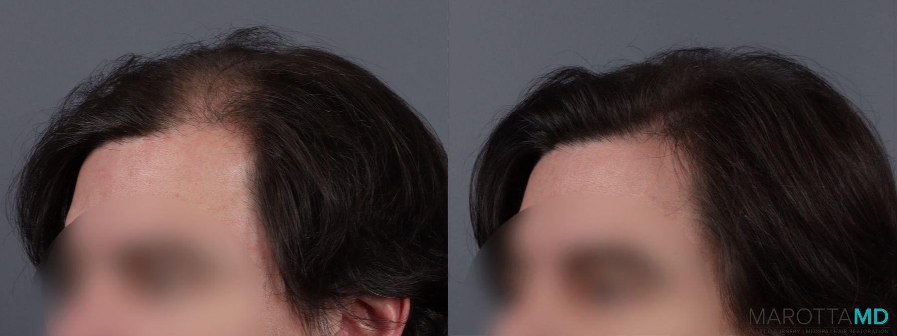 Before and after PRP Scalp Treatment case 13567 - Angle 2