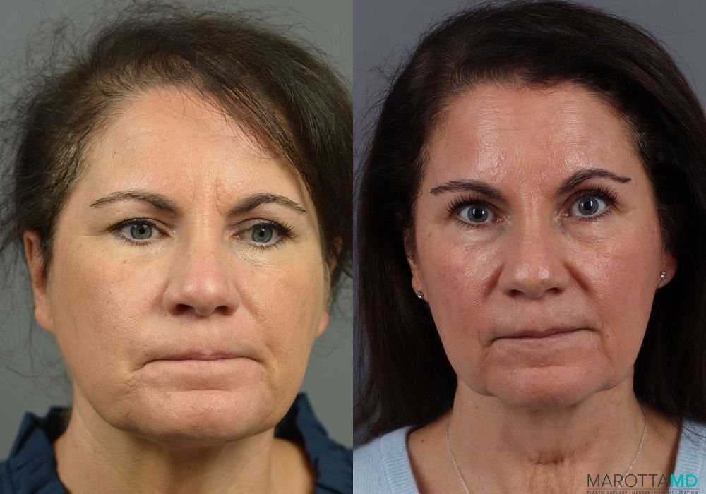 Before and after PRP Scalp Treatment case 7200 - Angle 5