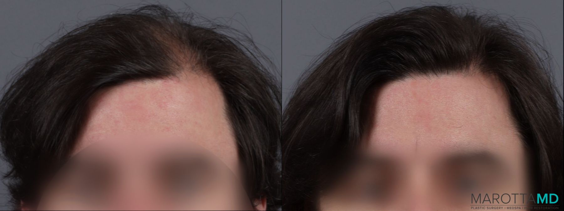 Before and after PRP Scalp Treatment case 13567