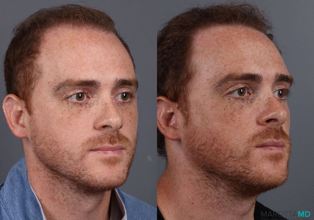 PRP Scalp Treatment - Thumbnail 2