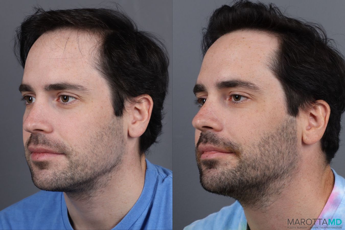 Before and after PRP Scalp Treatment case 13570 - Angle 2