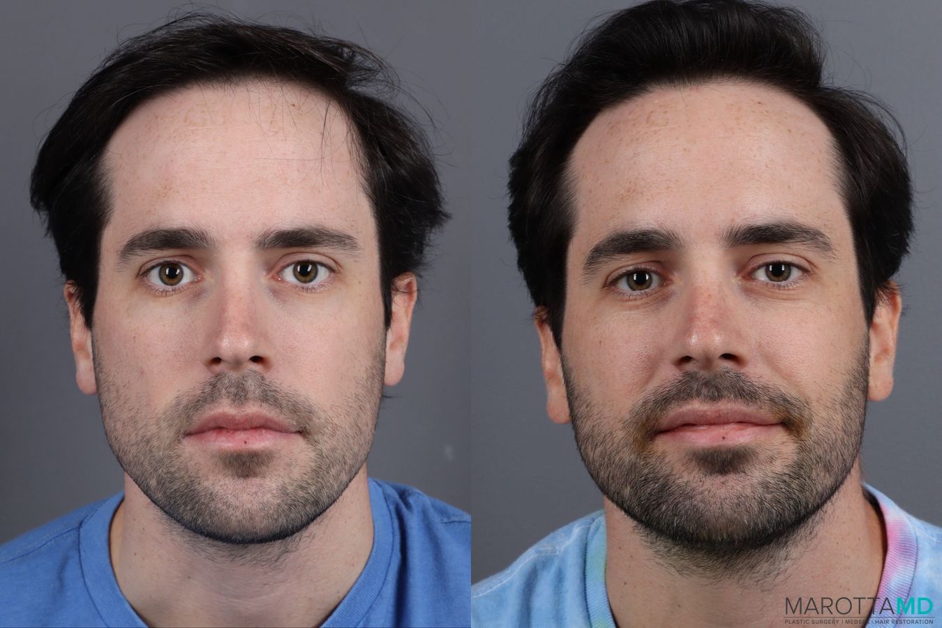 Before and after PRP Scalp Treatment case 13570