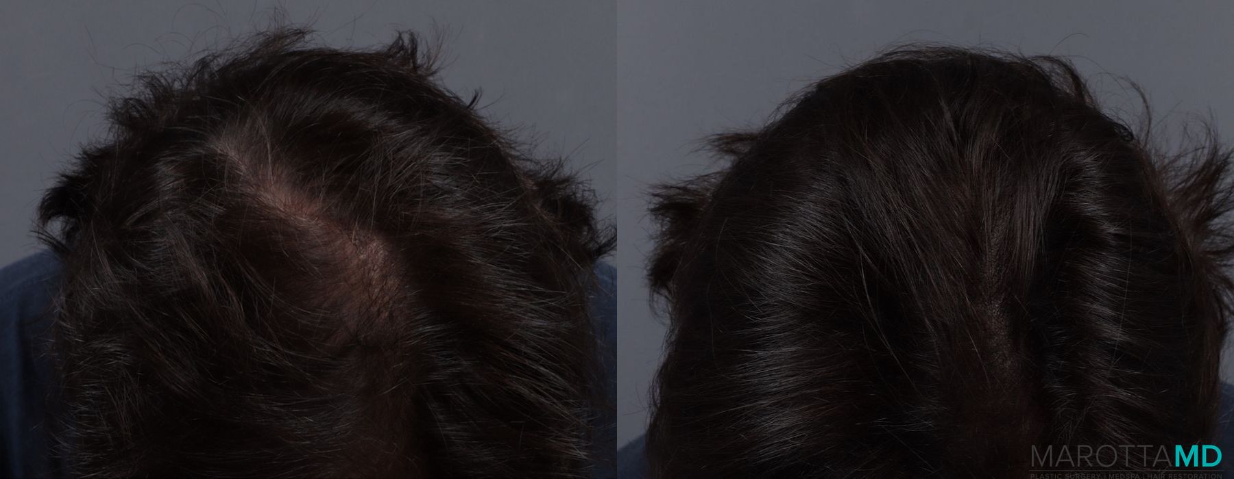 PRP Scalp Treatment - Thumbnail 2