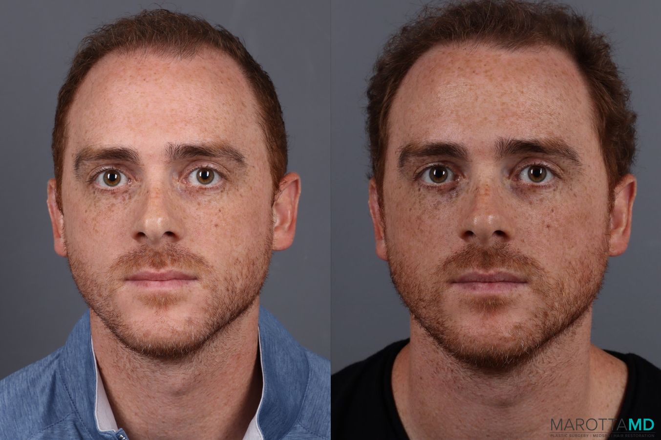 Before and after PRP Scalp Treatment case 7172