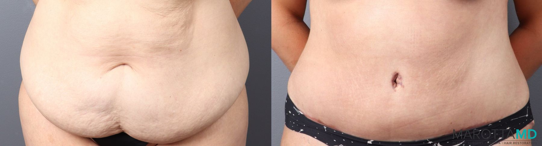 Before and after Panniculectomy case 43703