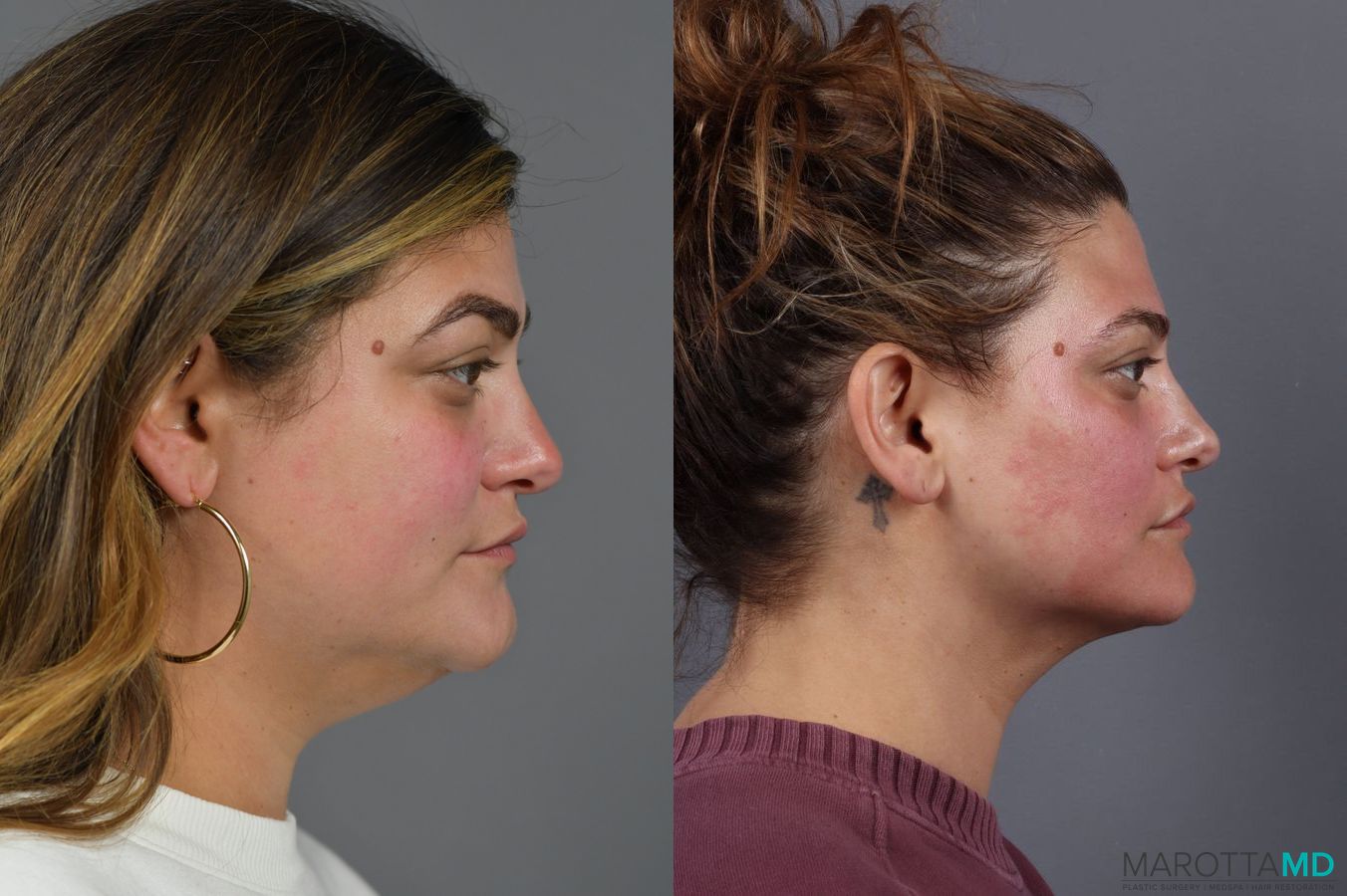 Before and after Renuvion case 6990 - Angle 3