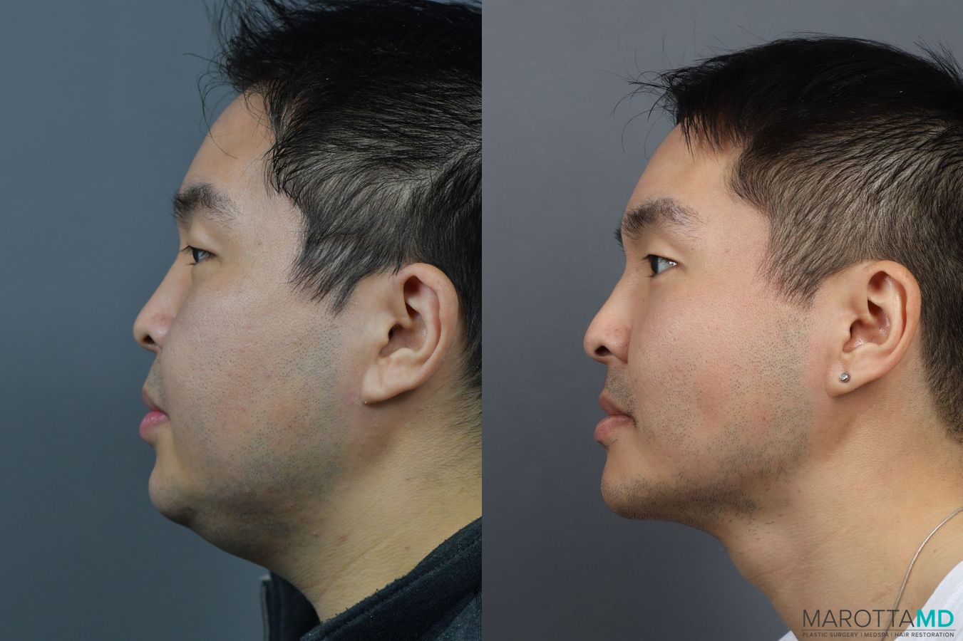 Before and after Renuvion case 7004 - Angle 3
