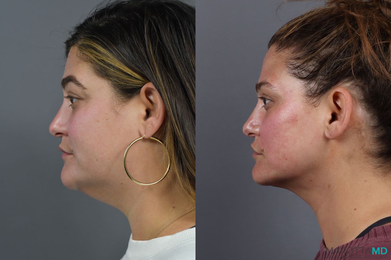 Before and after Renuvion case 6990 - Angle 2