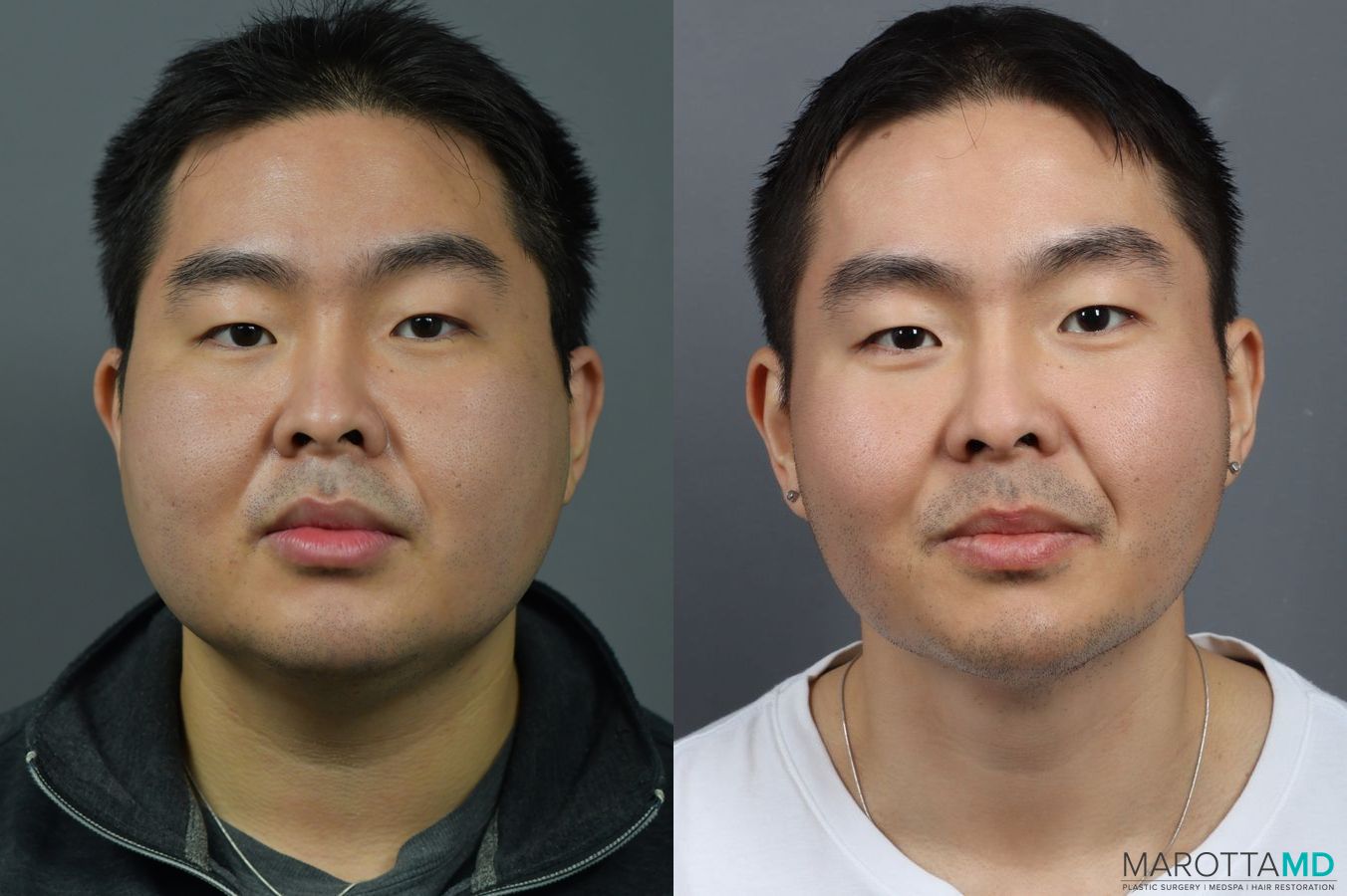 Before and after Renuvion case 7004