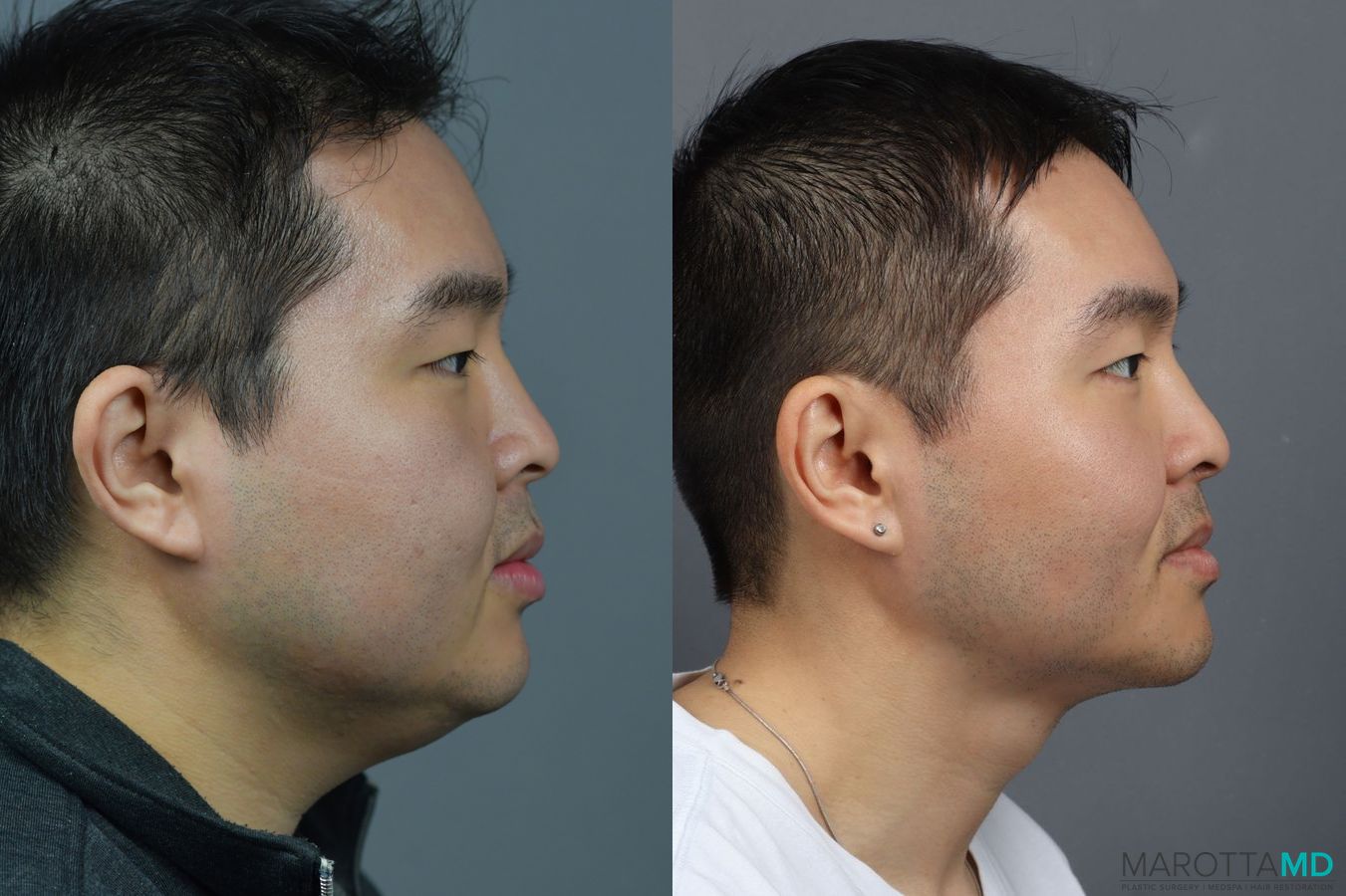 Before and after Renuvion case 7004 - Angle 2
