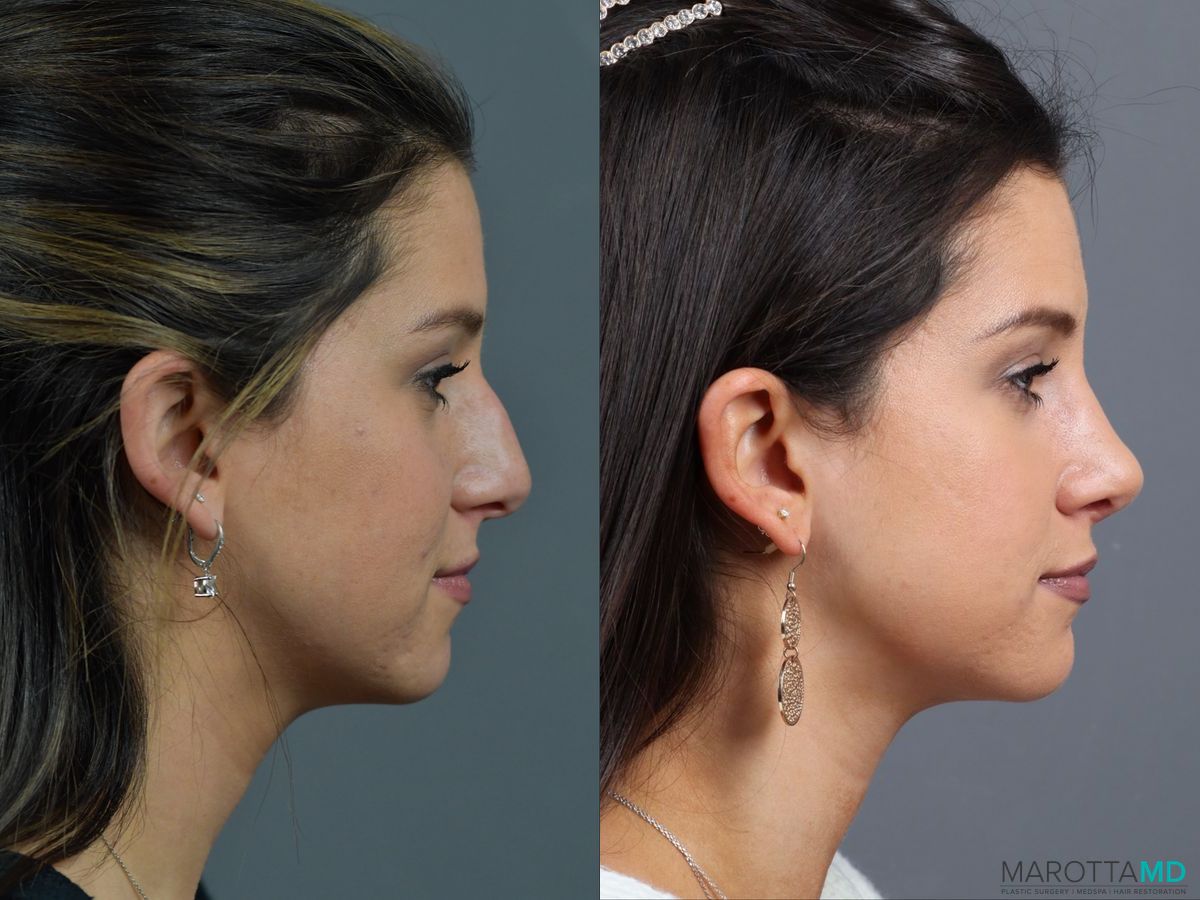 Before and after Rhinoplasty case 17407 - Angle 3