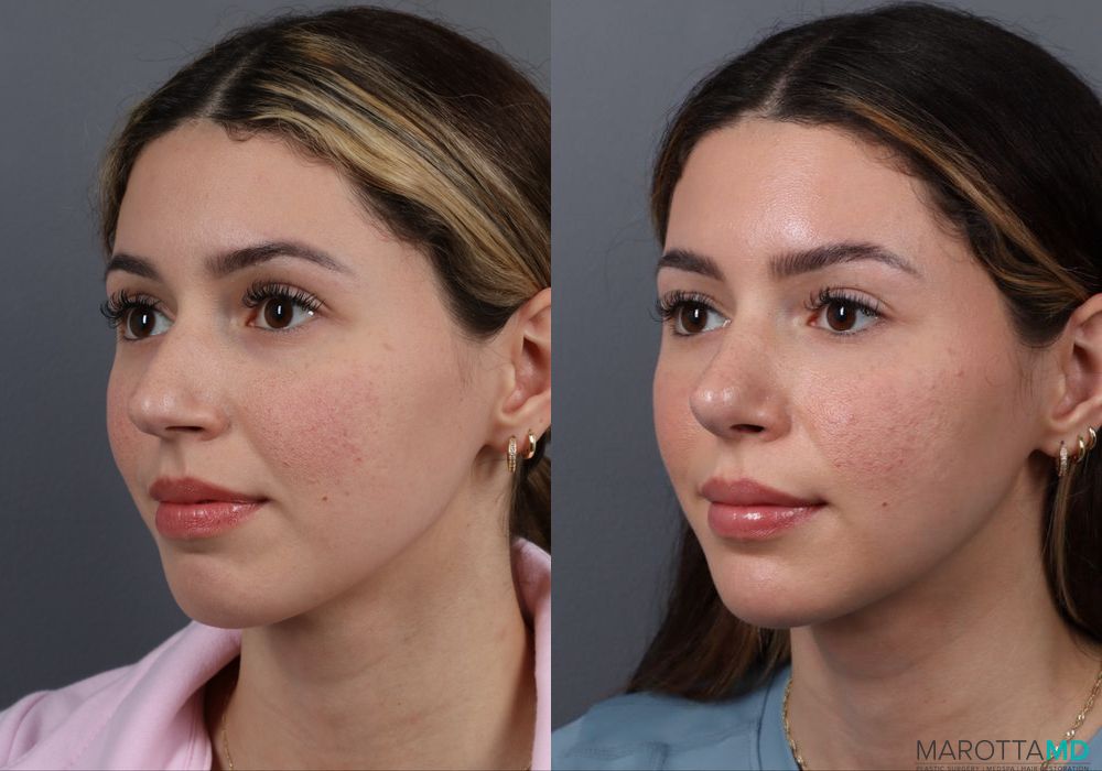 Rhinoplasty - Thumbnail 4