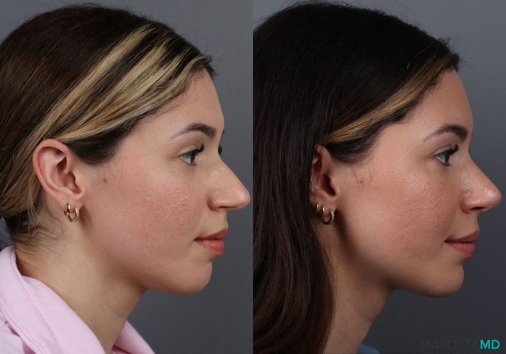 Rhinoplasty - Thumbnail 3