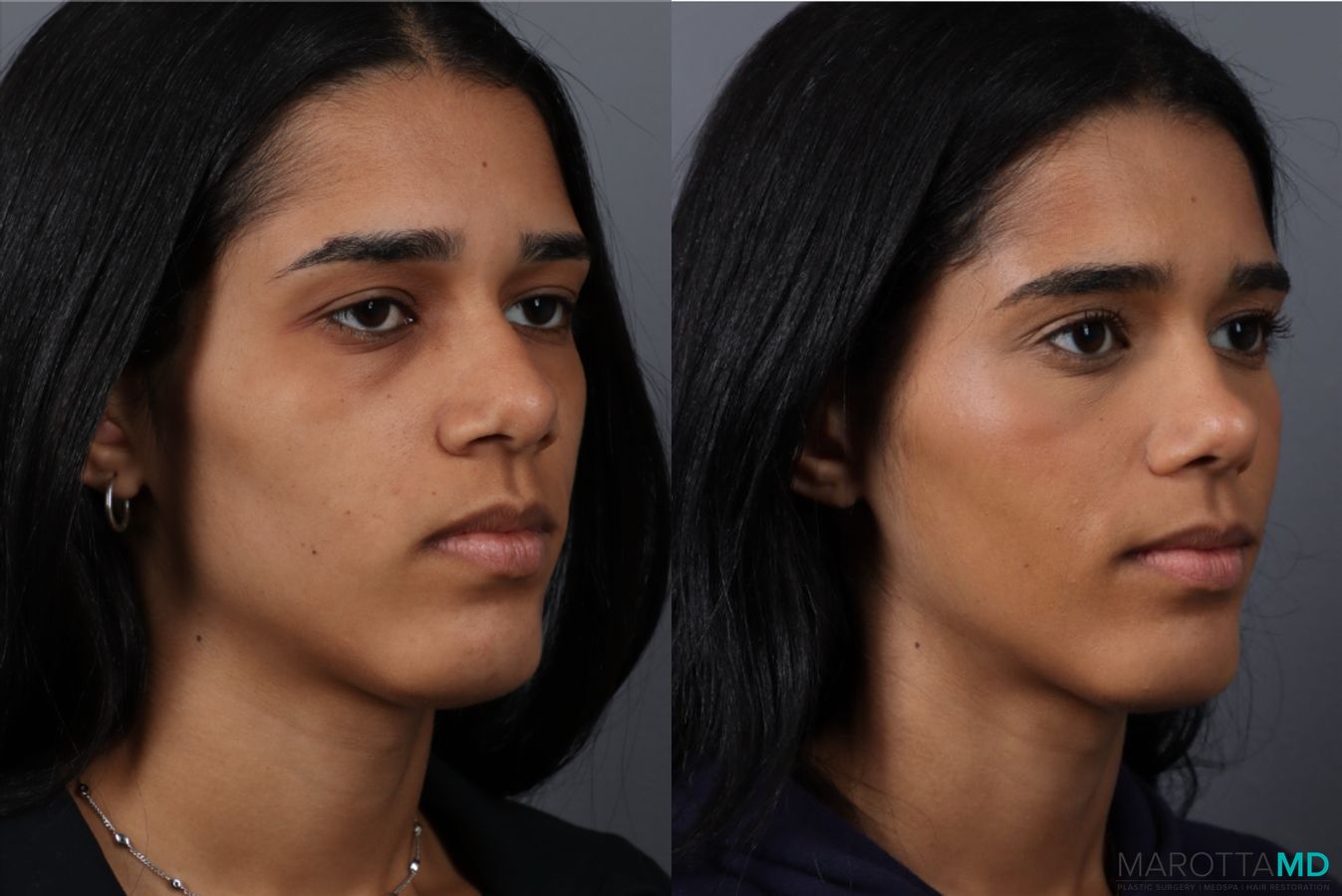 Before and after Rhinoplasty case 49459 - Angle 2