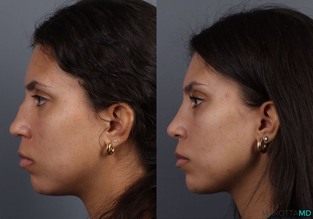 Rhinoplasty - Thumbnail 4