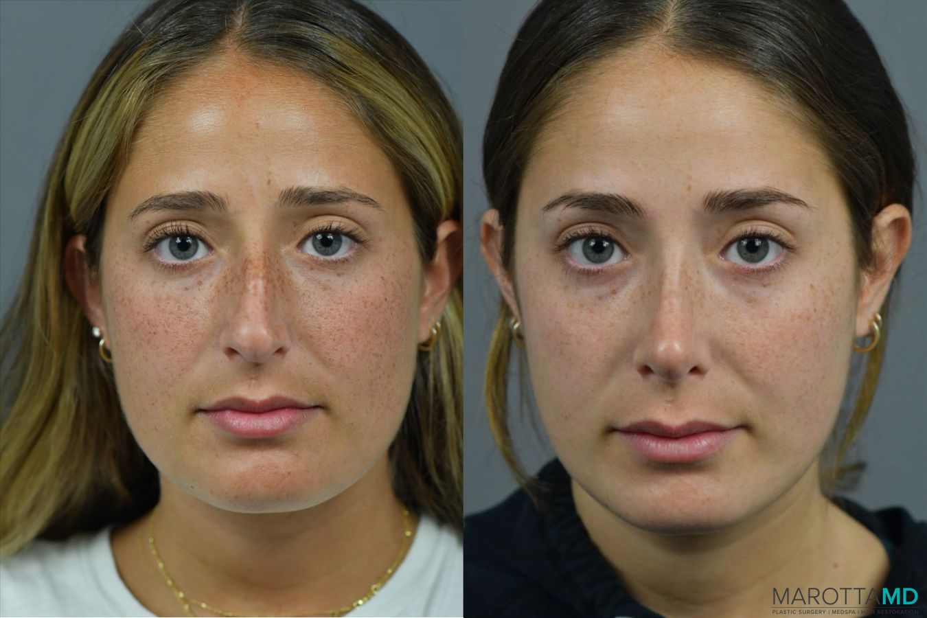 Before and after Rhinoplasty case 41923