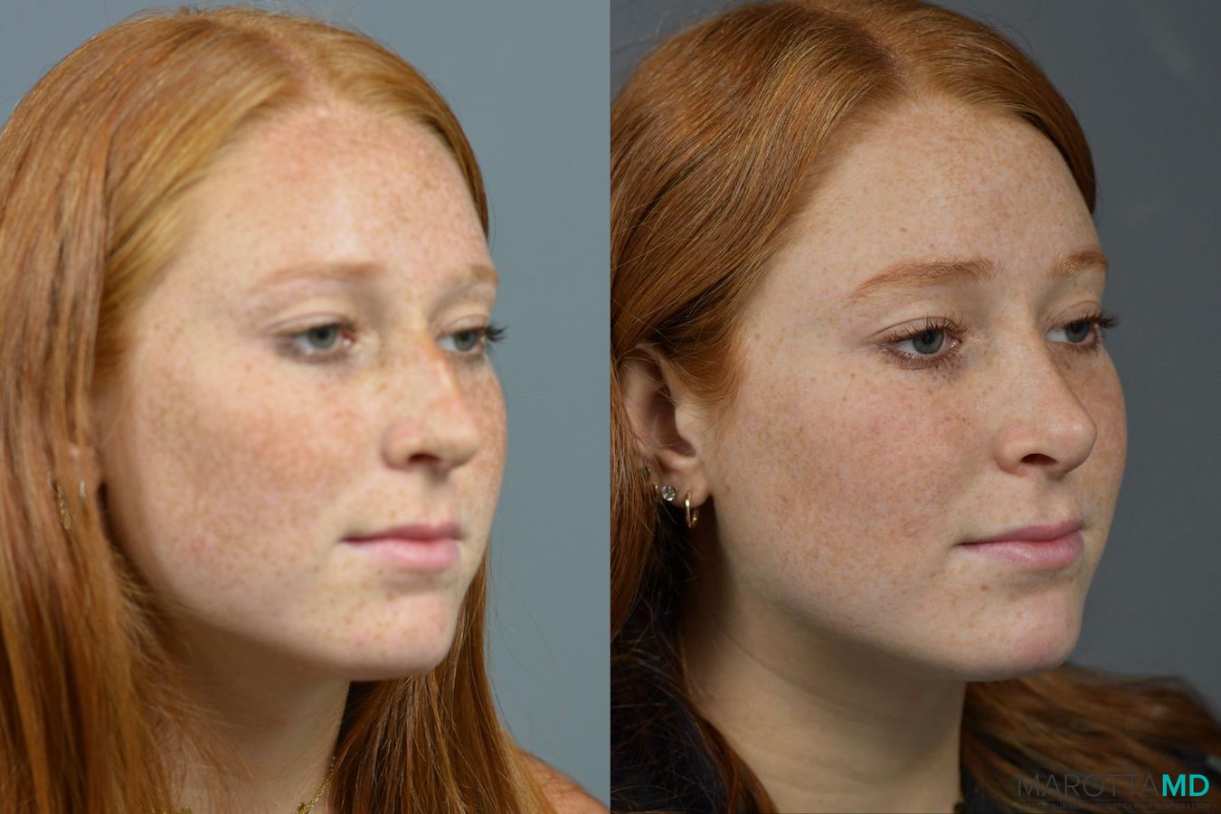 Before and after Rhinoplasty case 16102 - Angle 2