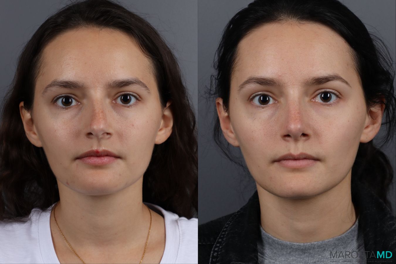 Before and after Rhinoplasty case 13237