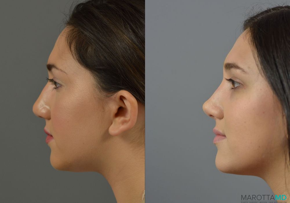 Rhinoplasty - Thumbnail 2