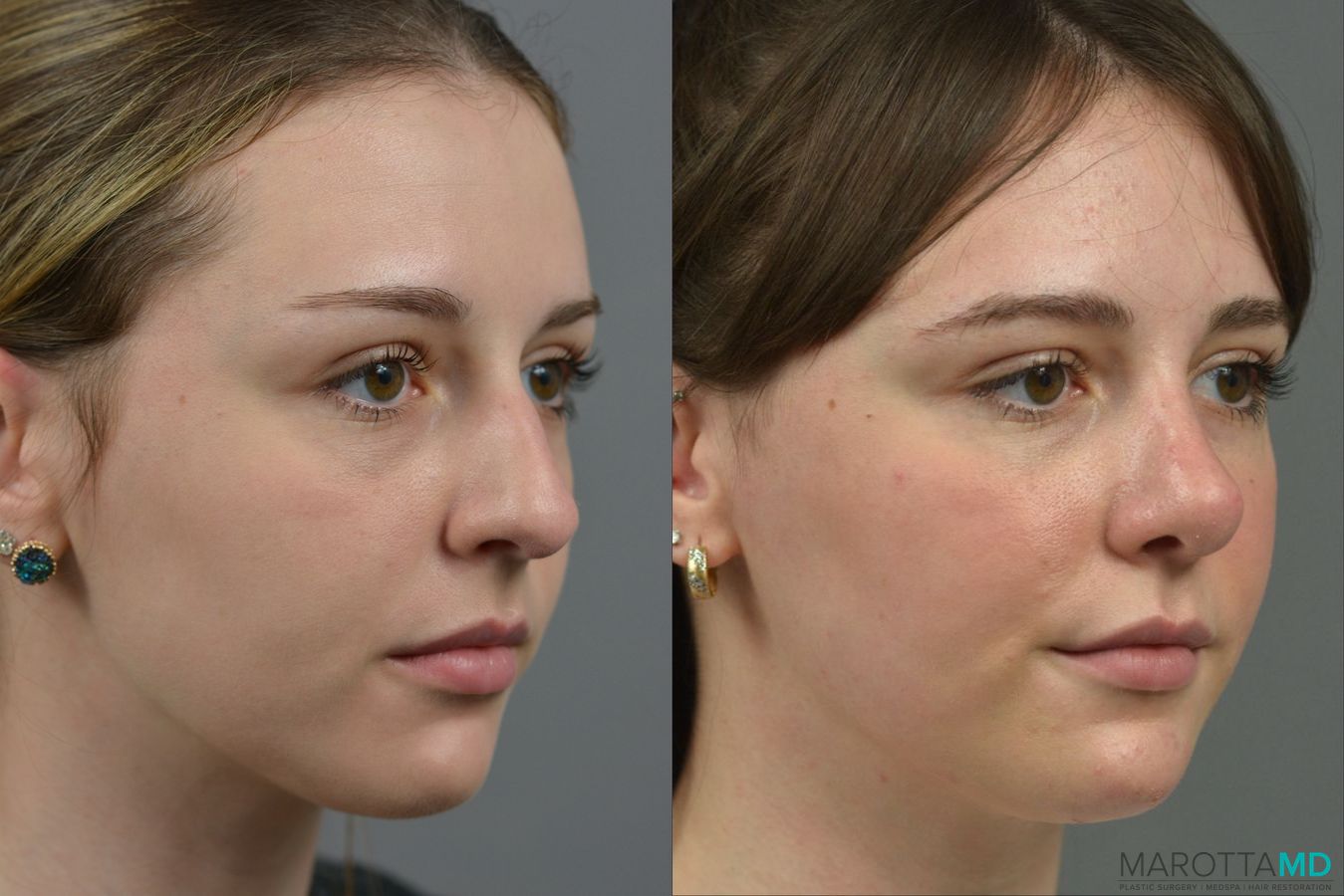 Before and after Rhinoplasty case 23770 - Angle 2