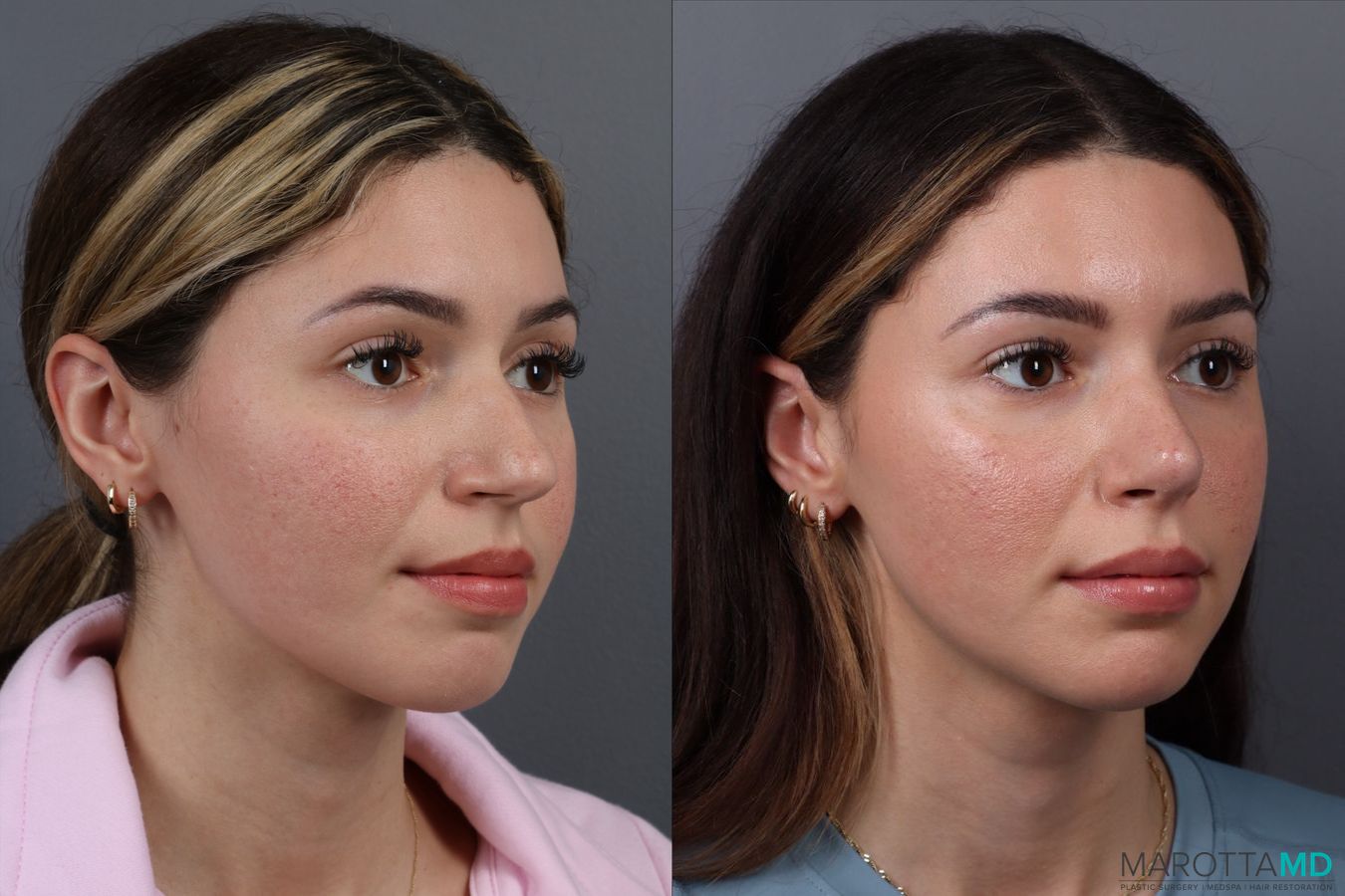 Before and after Rhinoplasty case 17177 - Angle 2