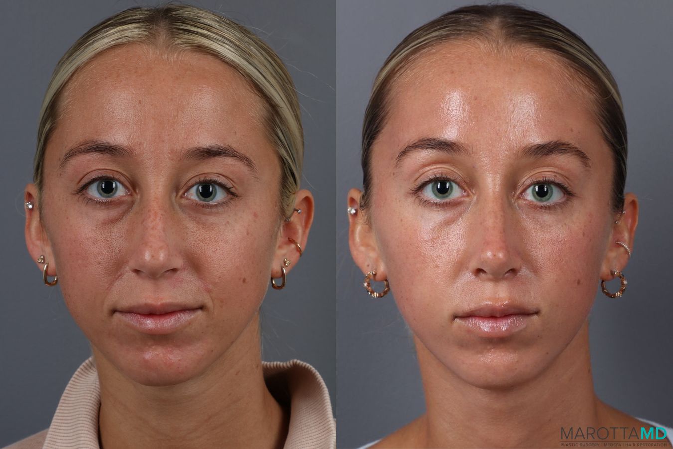 Before and after Rhinoplasty case 18368