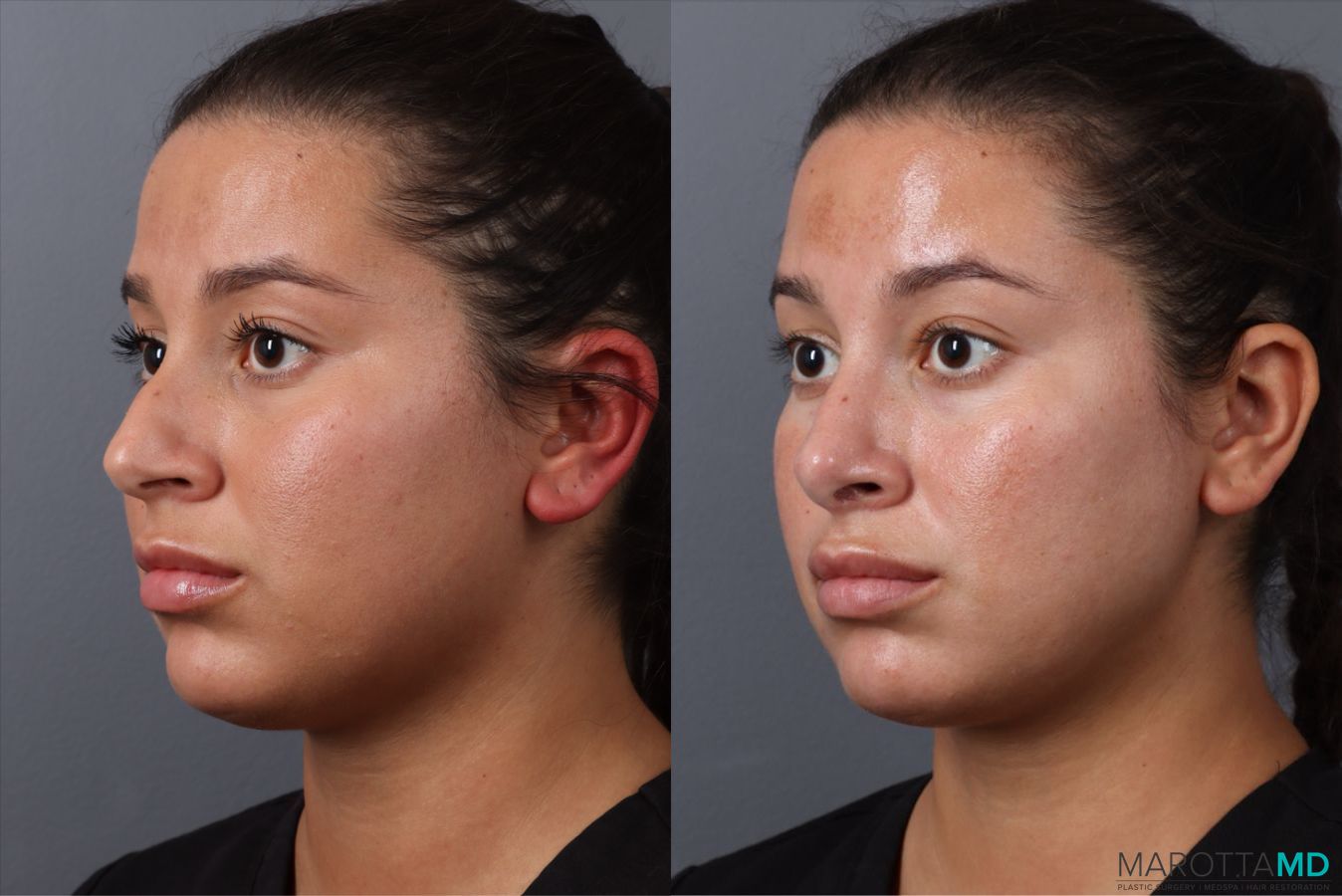Before and after Rhinoplasty case 49458 - Angle 4