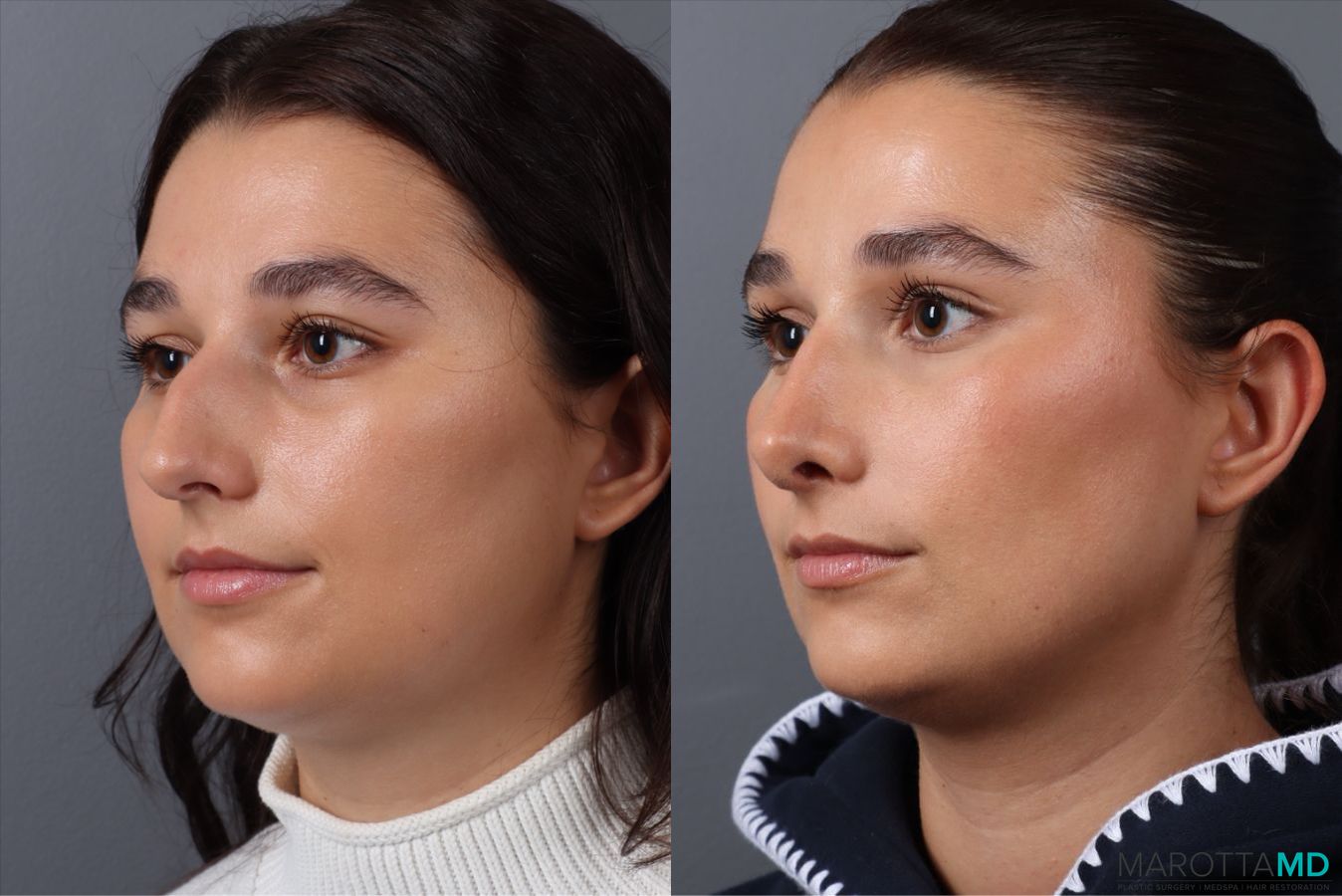 Before and after Rhinoplasty case 43704 - Angle 4