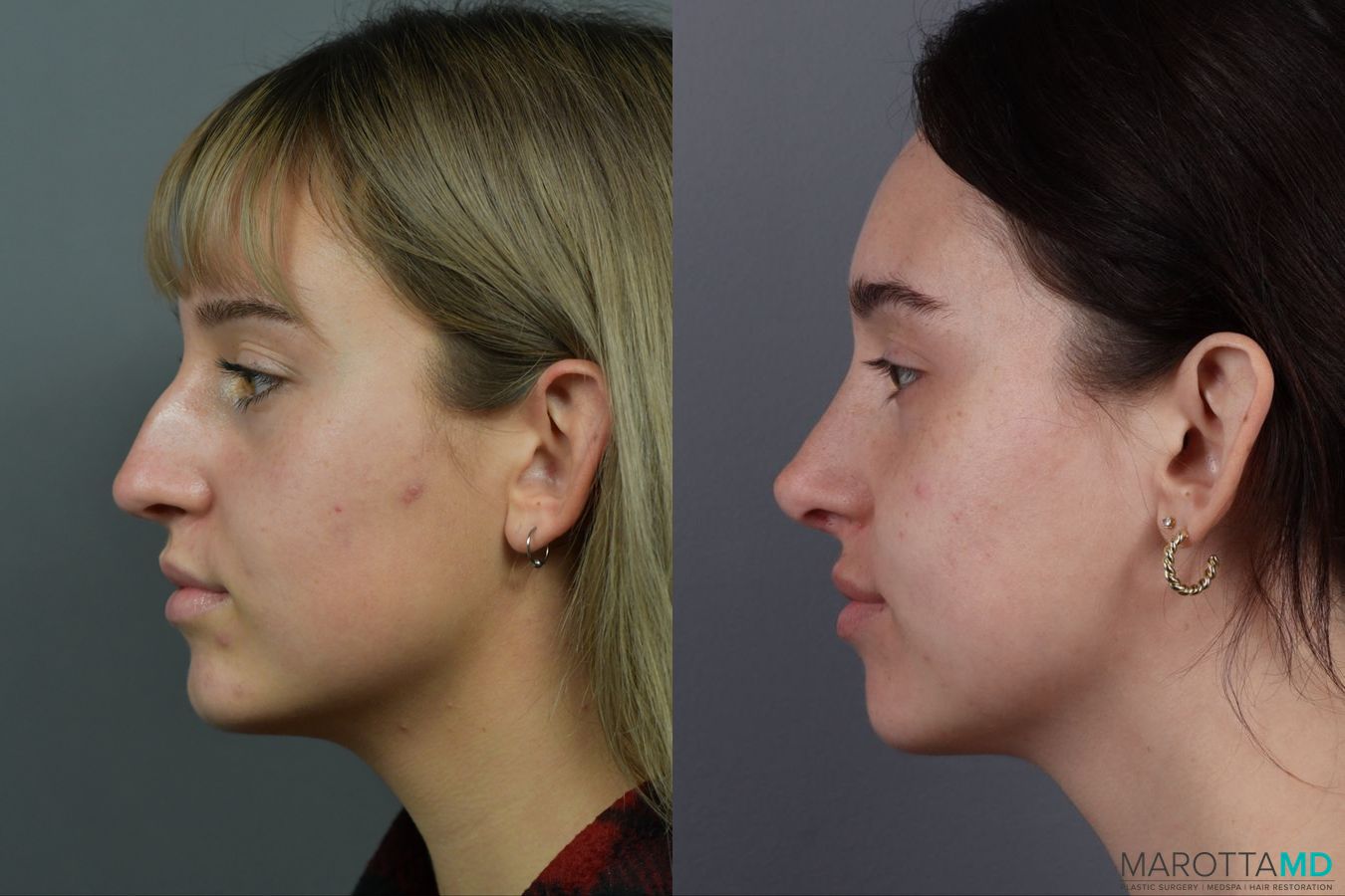 Before and after Rhinoplasty case 12317 - Angle 5