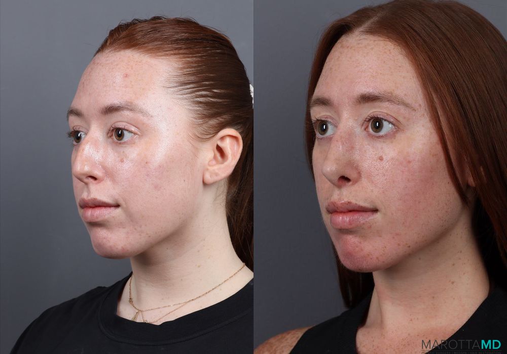 Rhinoplasty - Thumbnail 4