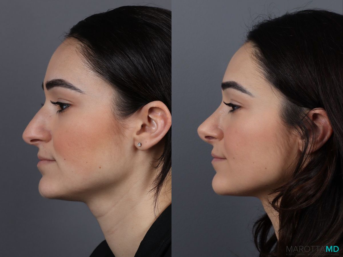 Before and after Rhinoplasty case 13004 - Angle 5