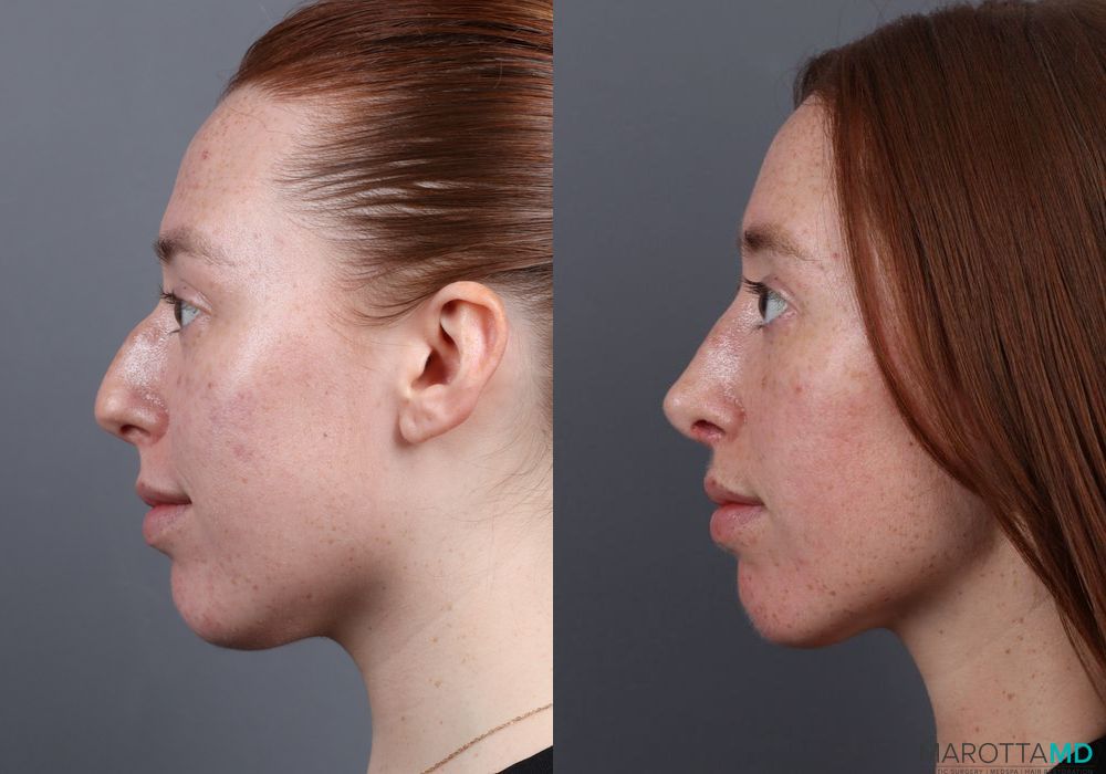 Rhinoplasty - Thumbnail 5