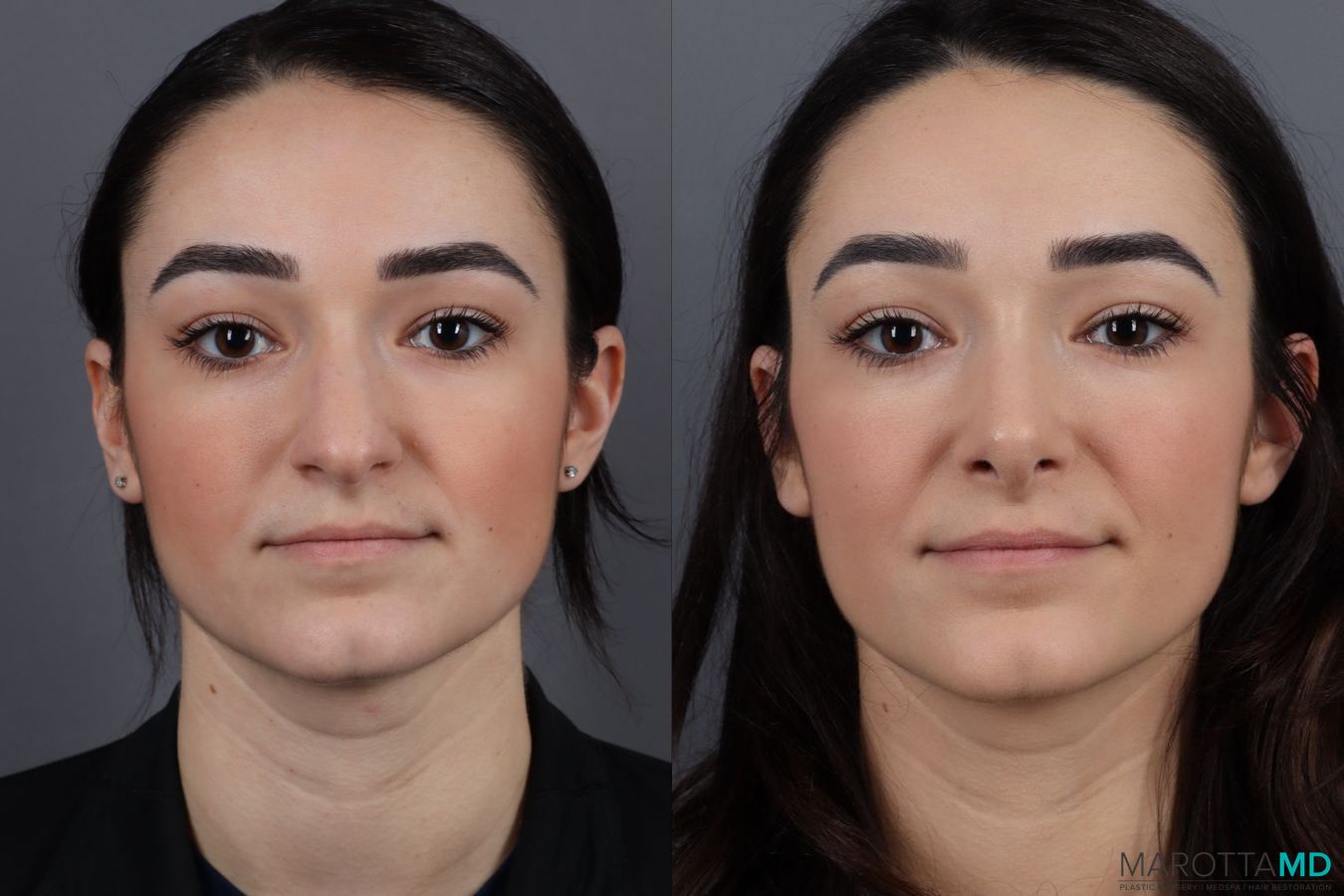 Before and after Rhinoplasty case 13004