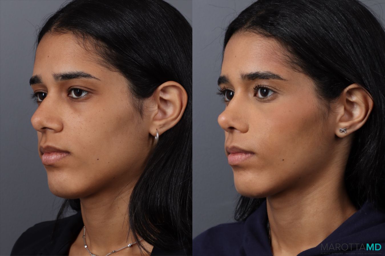 Before and after Rhinoplasty case 49459 - Angle 4